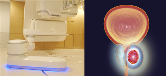 중입자치료기(왼쪽)와 전립선암 /사진제공=중입자치료지원센터코리아