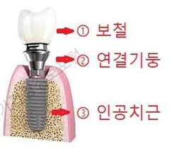 임플란트 구조 /자료=한국소비자원