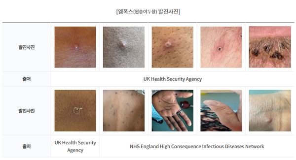 엠폭스 발진사진  /제공=울산시